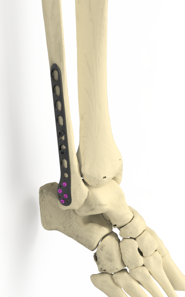Affinity Peroné Distal - Imagen 2