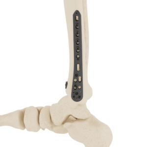 Affinity Tibia Distal