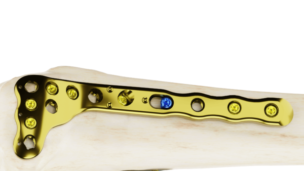 Affinity Tibia Proximal - Imagen 3