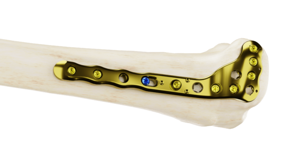 Affinity Tibia Proximal
