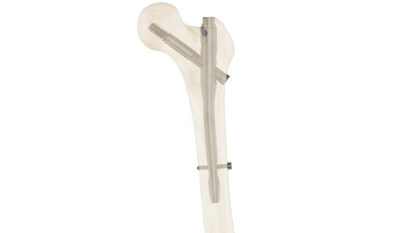 Clavo Support Fémur Proximal