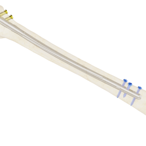 Clavo Support Reconstrucción Femoral