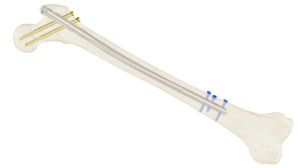 Clavo Support Reconstrucción Femoral