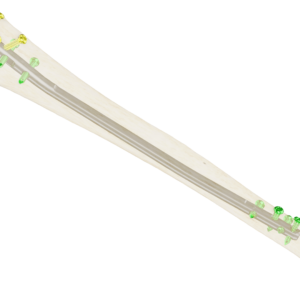 Clavo Support Reconstrucción Tibial