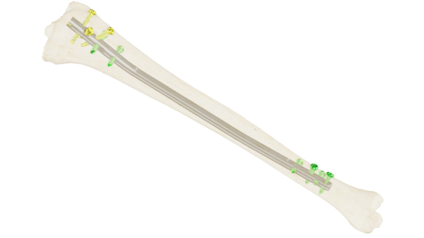 Clavo Support Reconstrucción Tibial