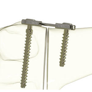 Epiflex