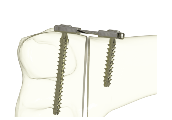 Epiflex